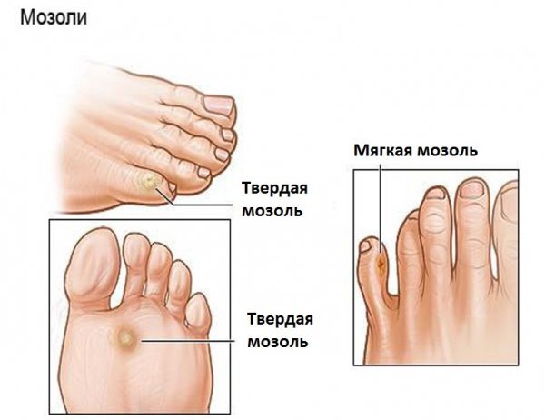 Как быстро избавиться от мозоли - вылечить её