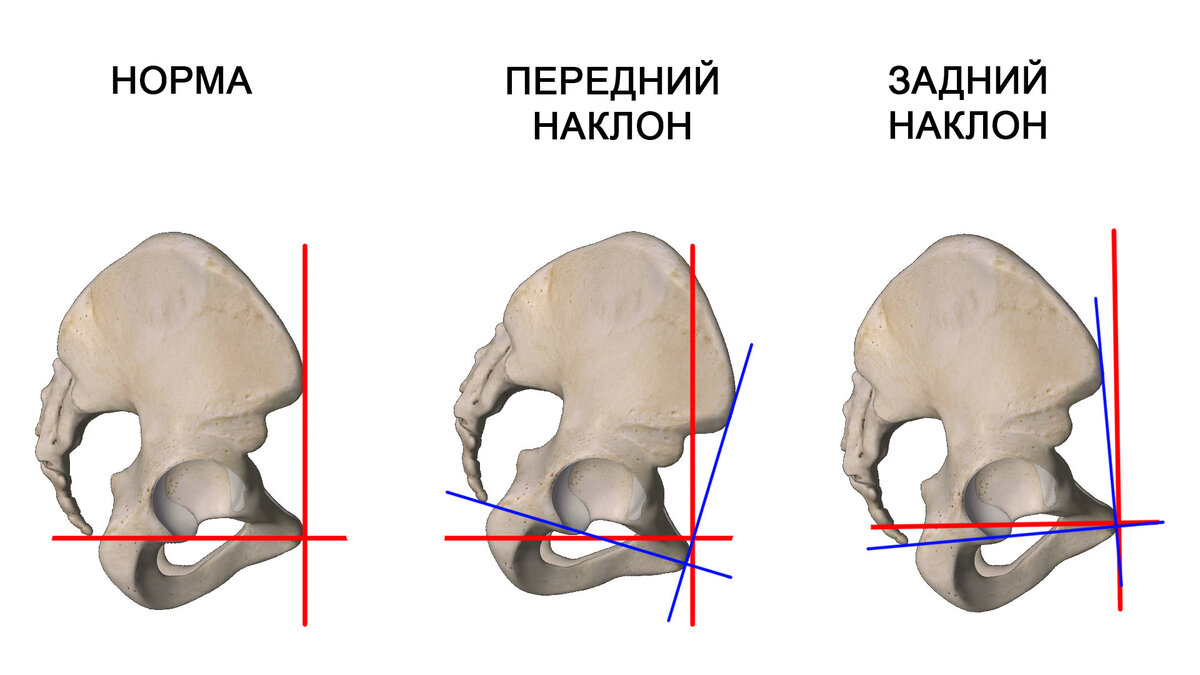 Наклон таза вперед фото