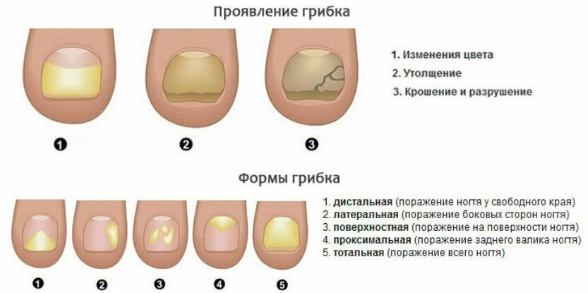 Признаки наличия грибка
