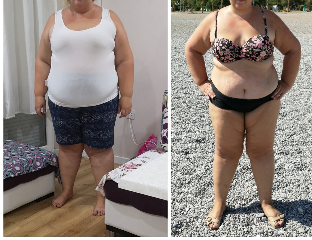 Фото до операции и минус 17кг,выше минус 21,6