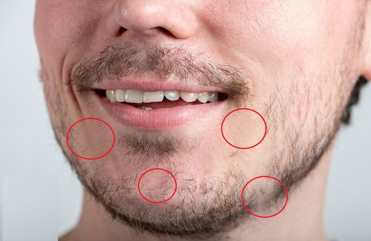 Пример плохого роста бороды.