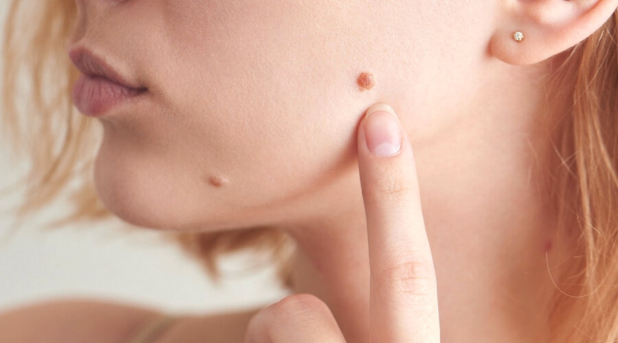 Родинка на лице - очень распространенное явление
