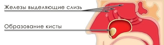 В итоге возникает шарообразное образование - это и есть гайморова киста. 