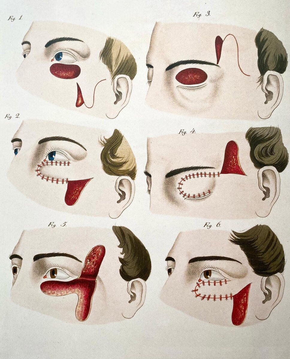 Операция Германа Фрице по подтяжке век. Можно полтягивать как верхнее, так и нижнее веко, а необходимый лоскут кожи беретс либо с виска, либо с щеки.