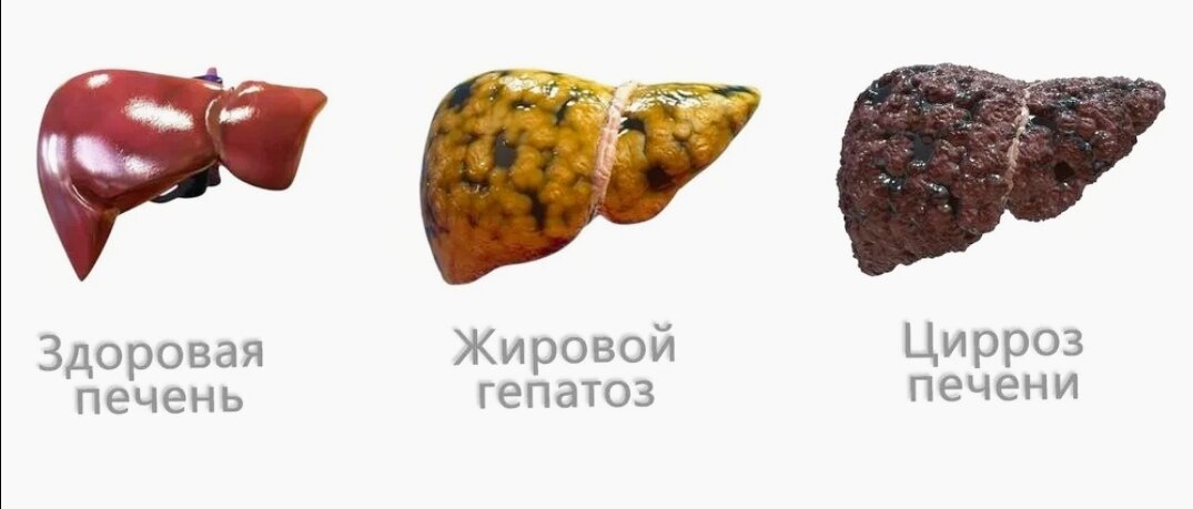Если гепатоз не вылечить, со временем он перейдёт в цирроз 