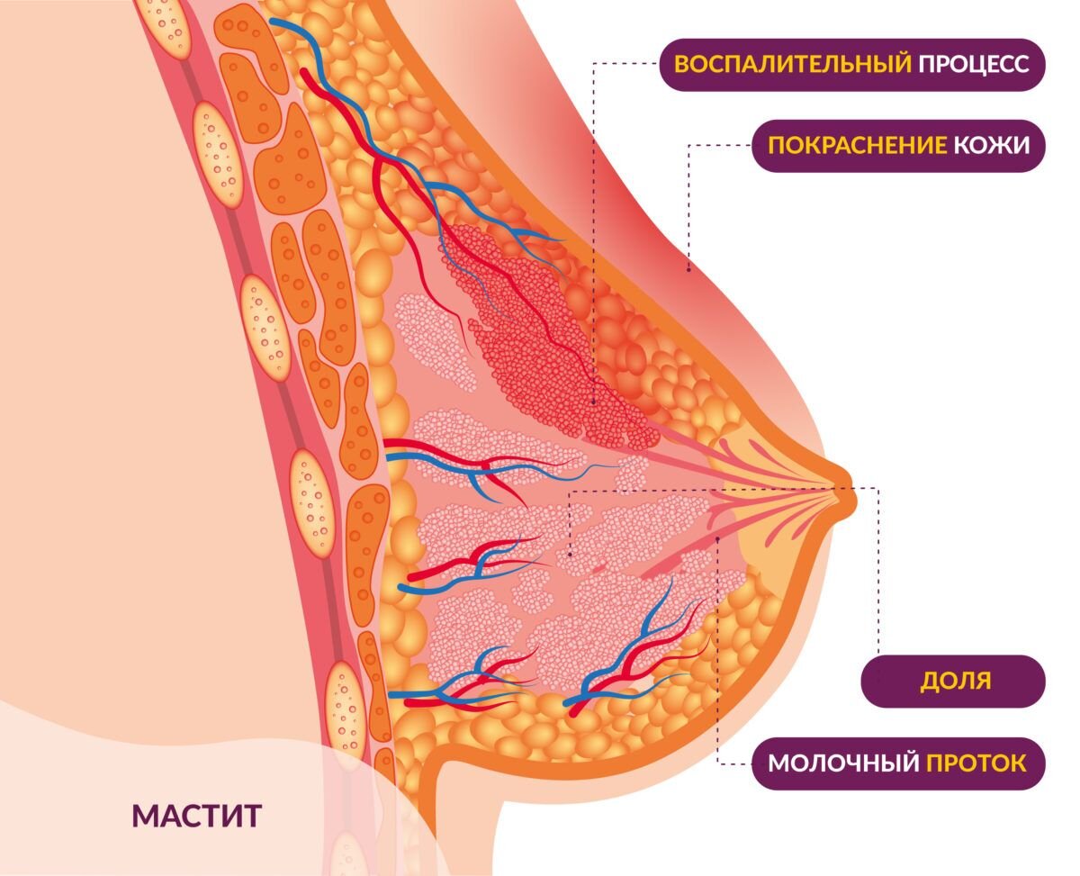 Молочная железа лечение. Нелактационный Гнойный мастит. Лактационный и нелактационный мастит. Серозный лактационный мастит. Мастит молочной железы симптомы.