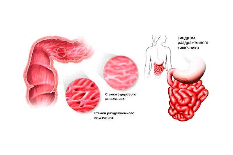 Лечение и профилактика синдрома раздраженного кишечника - Клиника Здоровье г. Екатеринбург