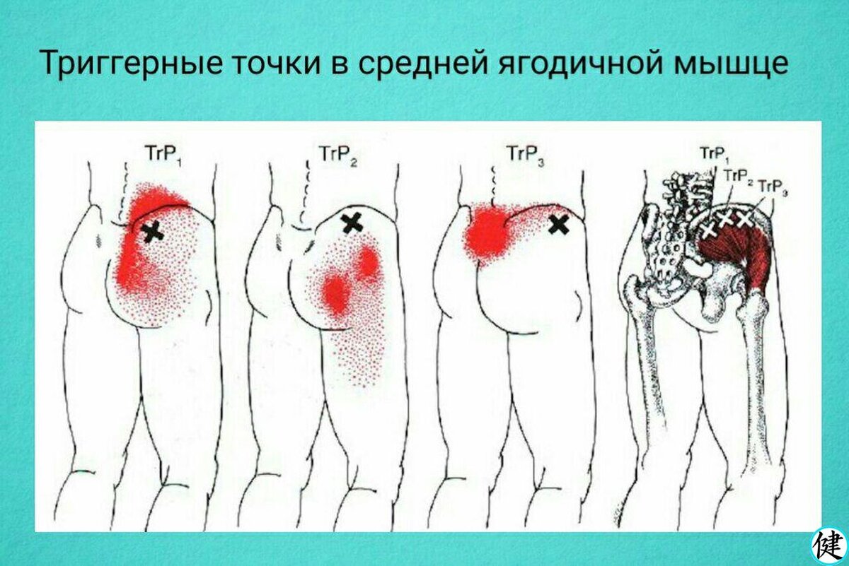 Триггерные точки в средней ягодичной мышце | Здоровье с нами | Дзен