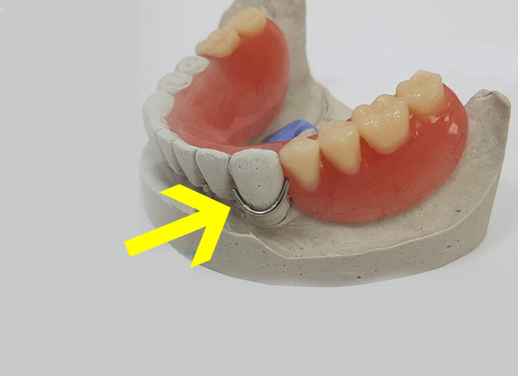 Проволочно-гнутый кламмер на пластмассовом зубном протезе.
