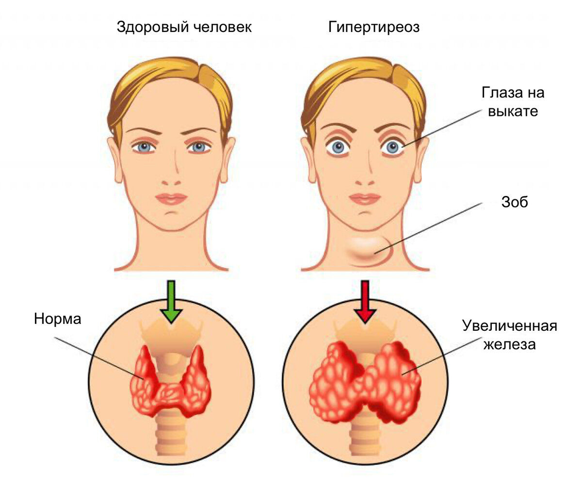 Гепатомегалия границы печени. Может ли быть увеличена. Степени увеличения щитовидной железы. Может ли быть увеличена. Щитовидка признаки заболевания у женщин.