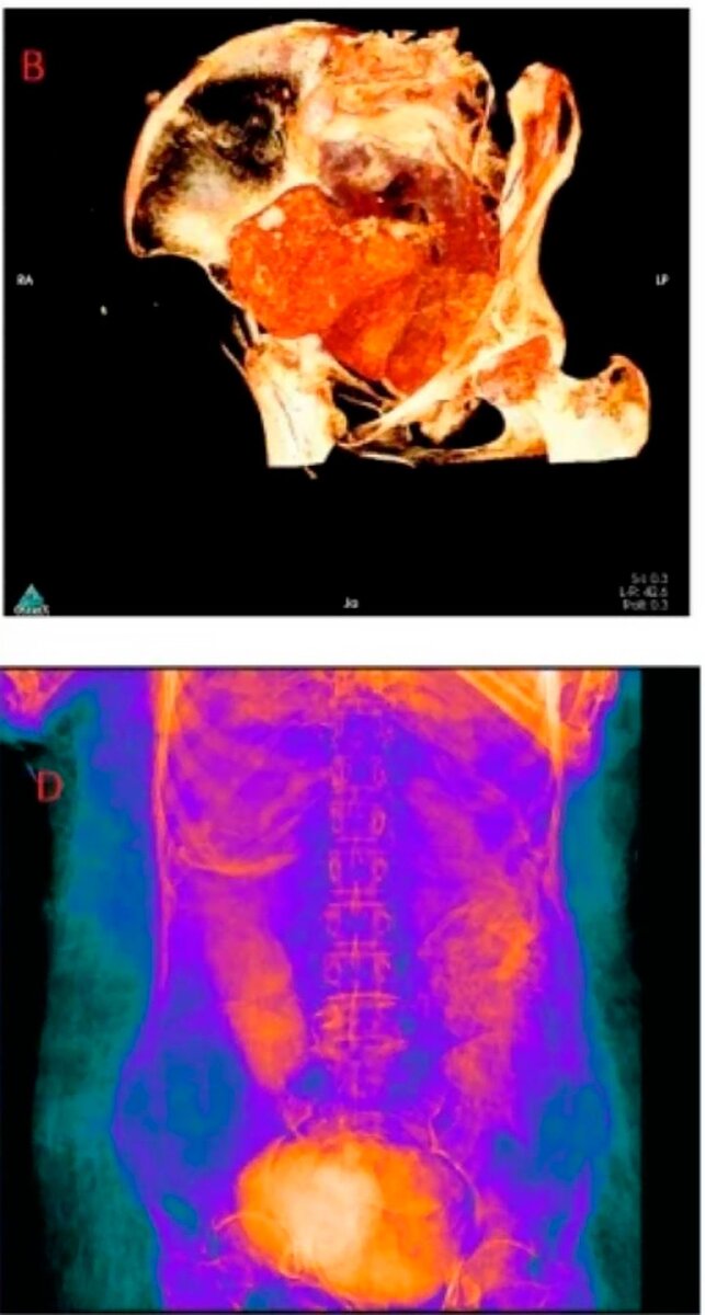     Внутри мумифицированной женщины нашли плод.