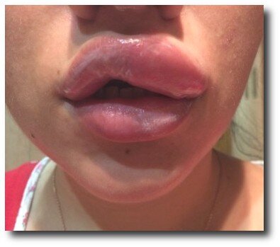 Реабилитация после увеличения губ гиалуроновой кислотой