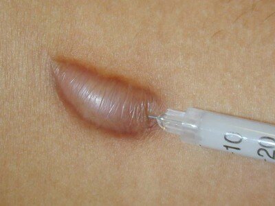 [caption id="attachment_1422" align="aligncenter" width="400"] Инъекция в келоидный рубец[/caption]