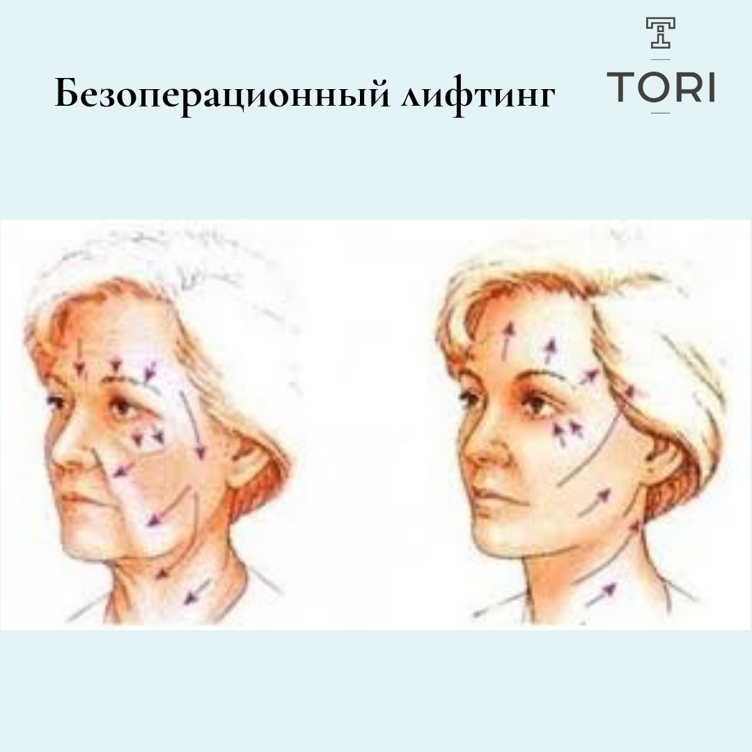 Смас массаж лица. Смас лифтинг зоны воздействия. Схема смас лифтинг лица.