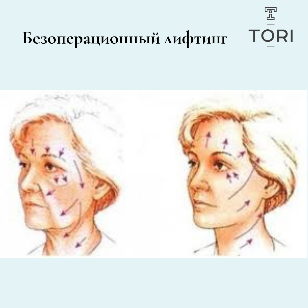 Rf лифтинг лица схема проведения процедуры