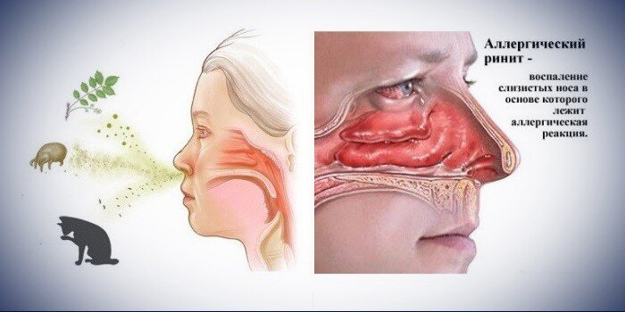 Поллиноз: как лечить аллергический ринит