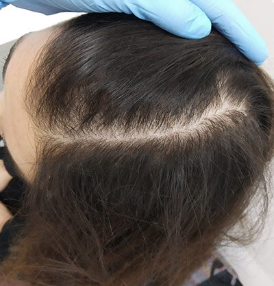 Волосы становятся тонкими и исчезают