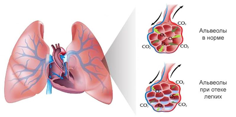 Отекли легкие причины. Альвеолярный отек легких. Альвеолярный отек легкого. Жидкость в альвеолах легких.