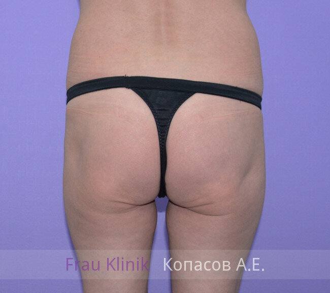 Липофилинг ягодицы: фото ДО (чтобы посмотреть результат операции, листайте галерею вправо)