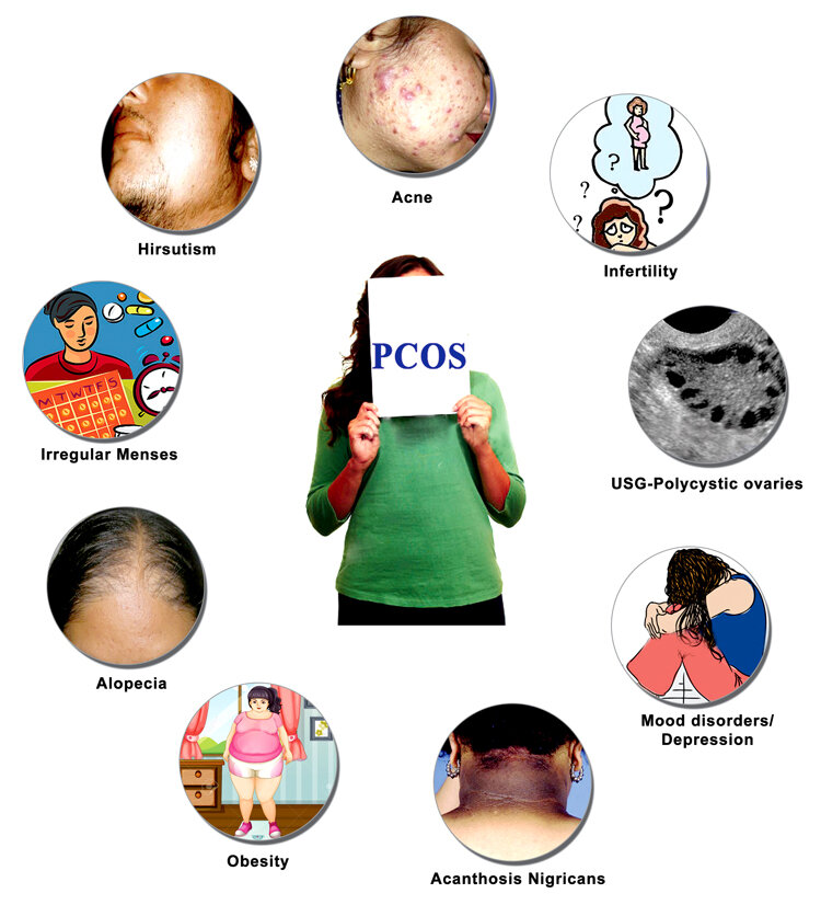 Проявления СПКЯ разнообразны.Ожирение,алопеция,нерегулярный цикл,гирсутизм,акне,бесплодие,нарушение настроения(депрессия).