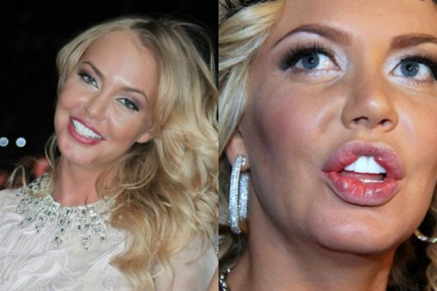 "Ужасно красивы". 7 звезд шоу-бизнеса, которые изувечили себя пластикой