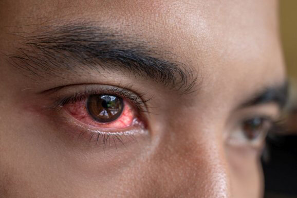 Психосоматика аллергии на глазах: причины и лечение