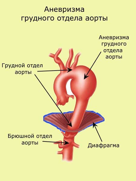 Факторы риска развития аневризмы брюшной аорты