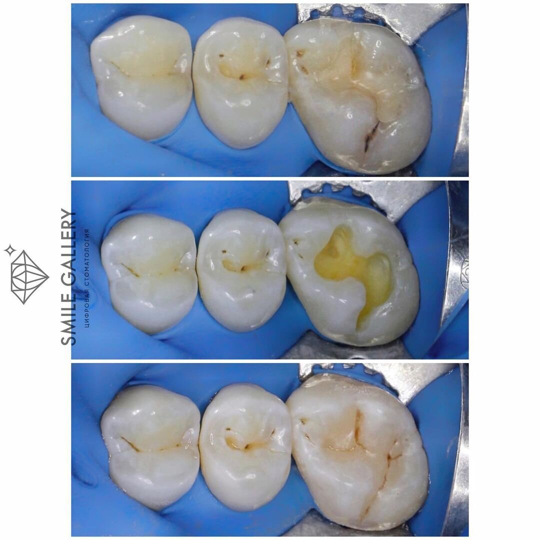 На фото показана замена несостоятельной реставрации зуба