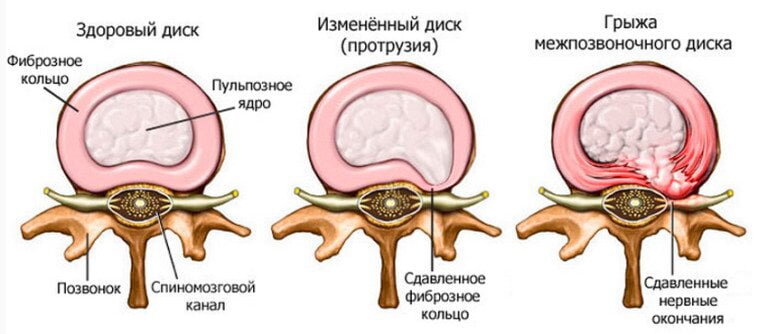 Схема позволяет понять отличие протрузии от грыжи межпозвоночного диска