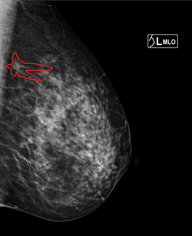 Левой молочной железы. Маммограмма молочных желез. Маммография молочной железы. Маммография опухоль молочной железы. Квадранты молочных желез.