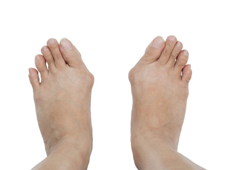 Нога стала ватной. Bunion hallux valgus. Молоткообразная деформация вальгус.