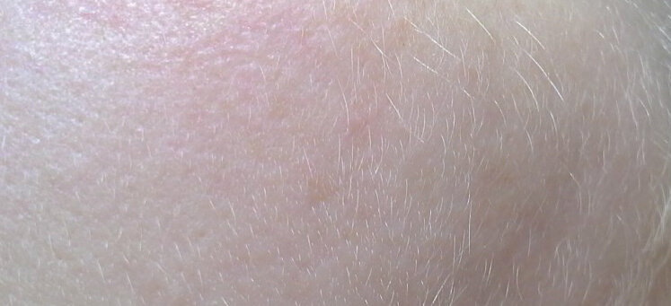 Последствия лечения выпадения волос на голове — рост пушковых волос на щеках.