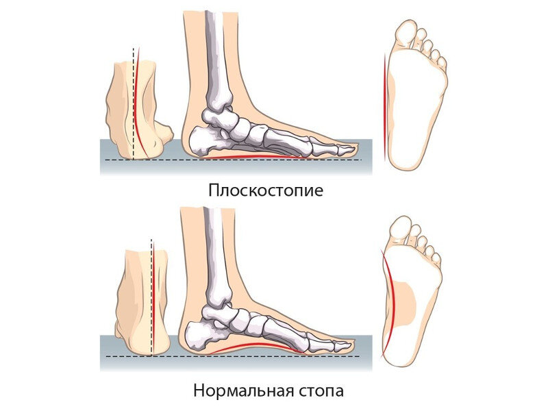 Залом это деформация