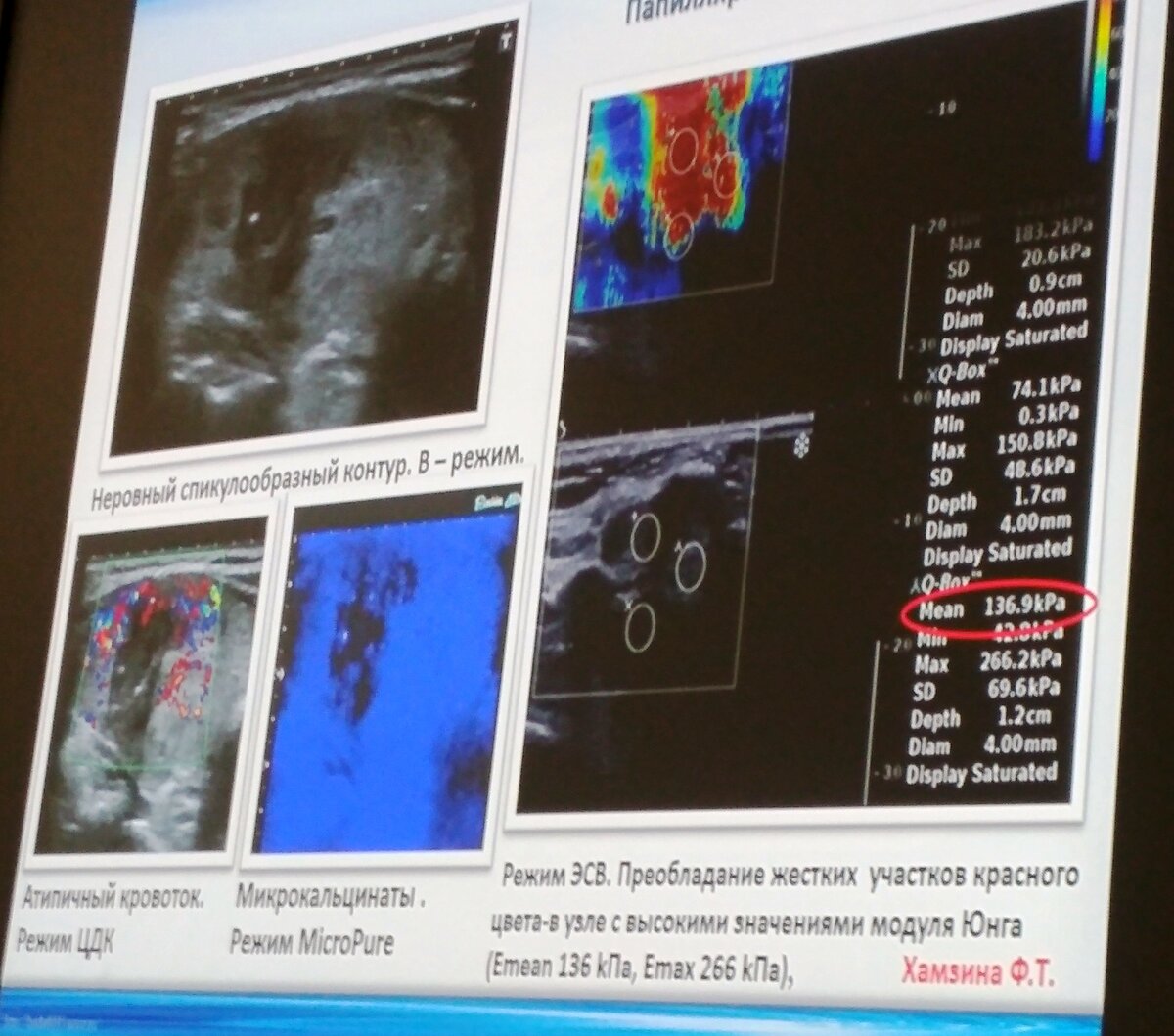 УЗИ узлов щитовидной железы. Эластография и контрастирование (2-й день VIII съезда специалистов УЗД)