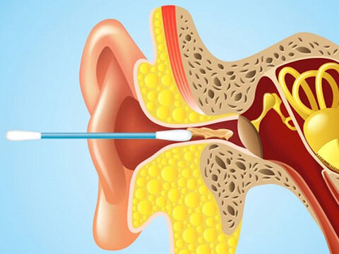 Убираем серную пробку из уха - домашние методы и средства