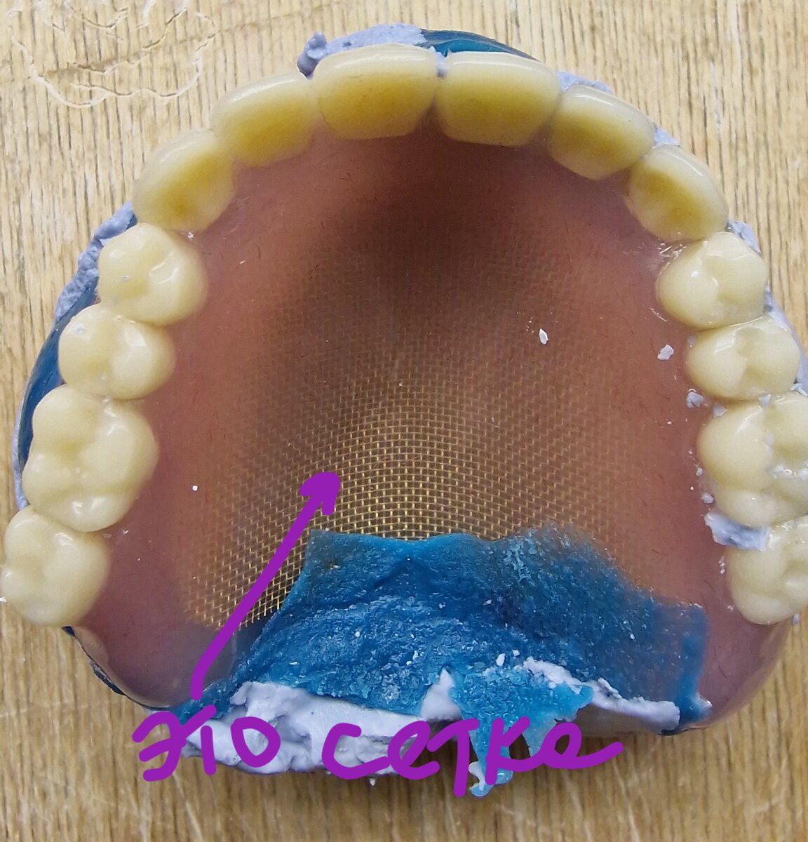 Этот протез отправлен на перебазировку(он плохо держится). Так как прошлый протез часто ломался,то в новый поставили сетку. Её видно на фото.