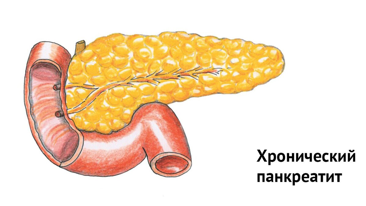 Здоровье поджелудочной. Хронический панкреатит симптомы. Патогенетические факторы хронического панкреатита. Острый панкреатит у собаки.