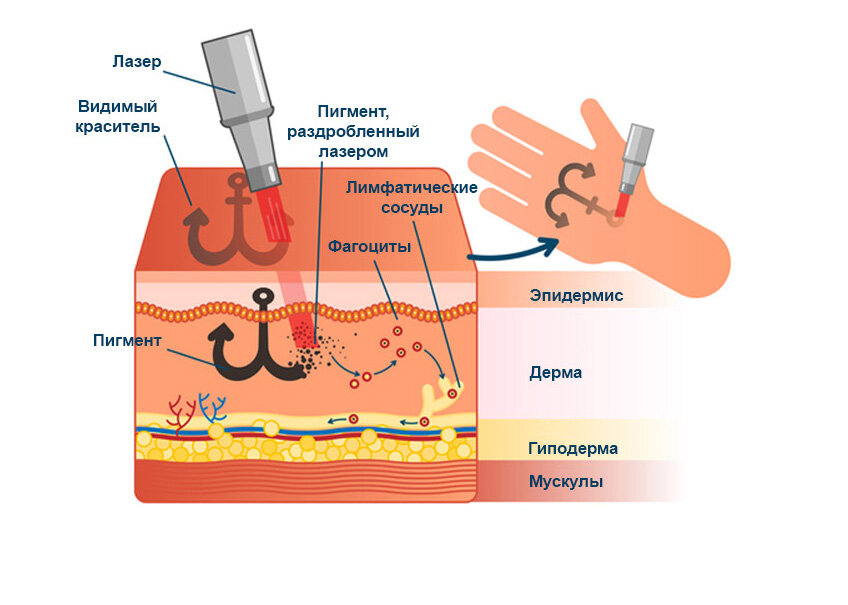 Пигмент под кожей. Воздействие лазера на кожу. Воздействие неодимового лазера на кожу. Влияние лазера на кожу человека. Введение пигмента в кожу.