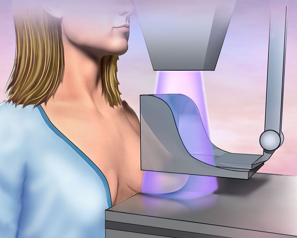 Опасность маммографии: как уберечь себя от рака груди!