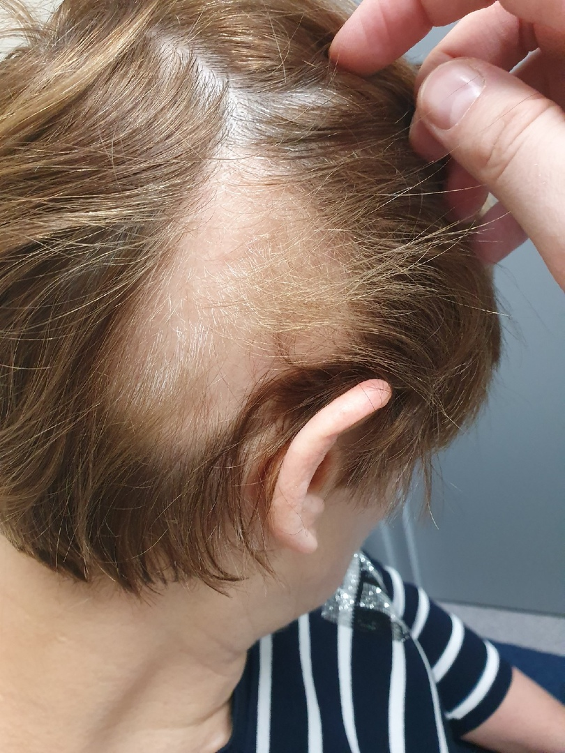 Очаговая алопеция