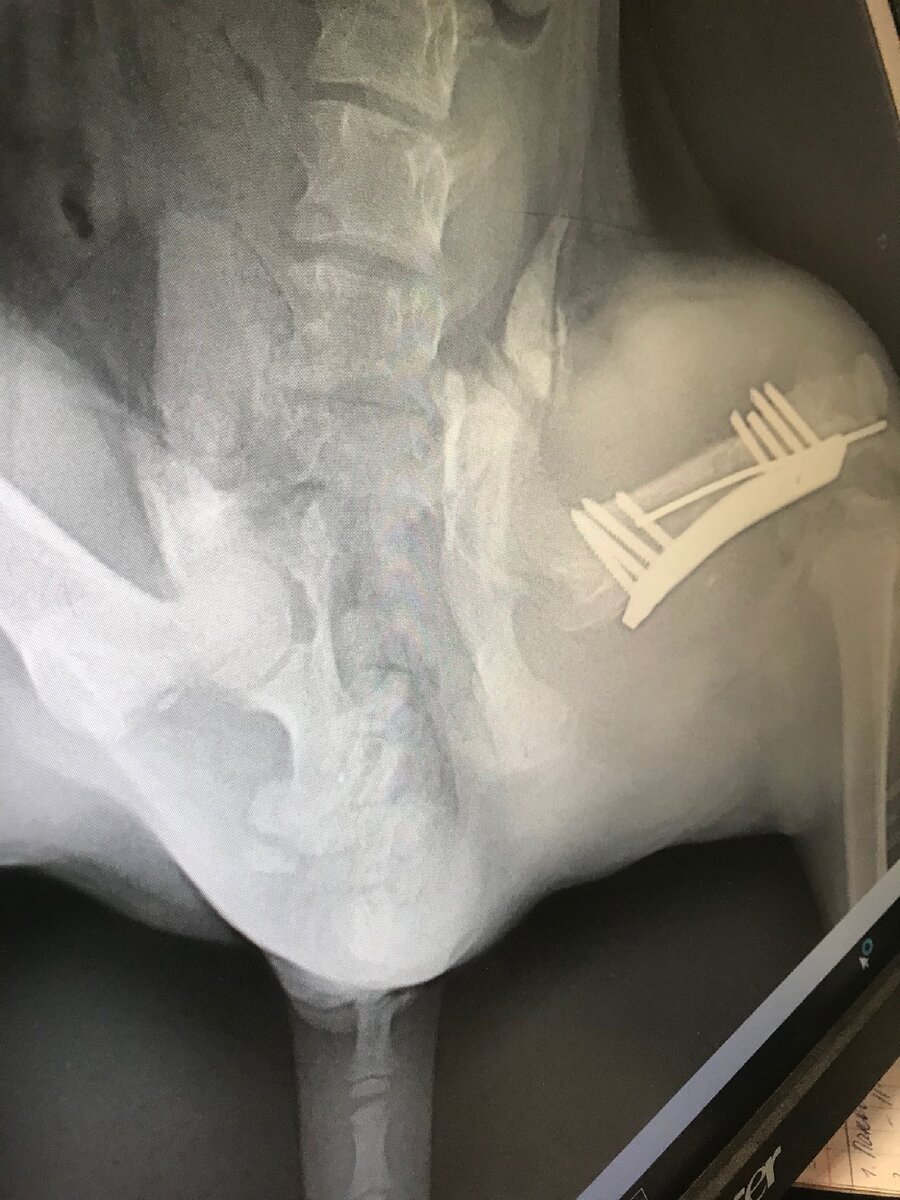 Первый рентген после операции. Фото автора: Зоидзе Софико 