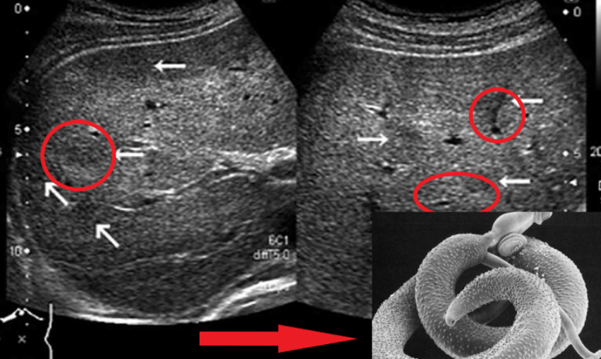 Глисты на узи. Видно ли гельминтов на УЗИ. Видно ли паразитов на УЗИ.