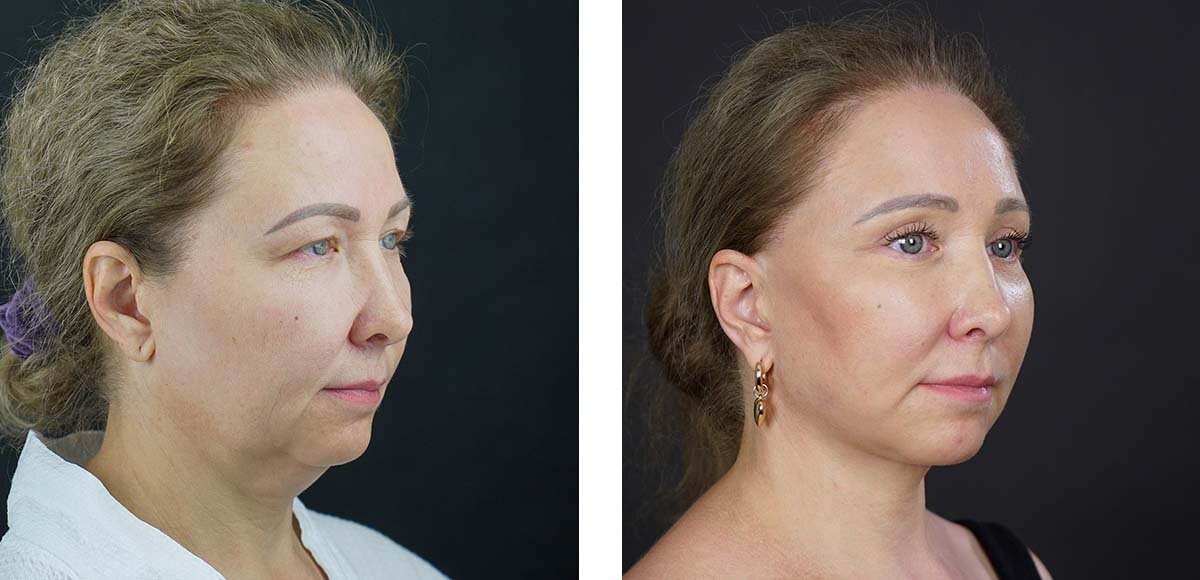 Результат круговой подтяжки лица и круговой блефаропластики спустя полтора года после операции. Пациентке на момент операции 49 лет. 