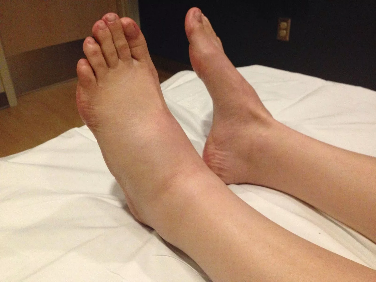Отёк ног после спинальной анестезии: причины, лечение