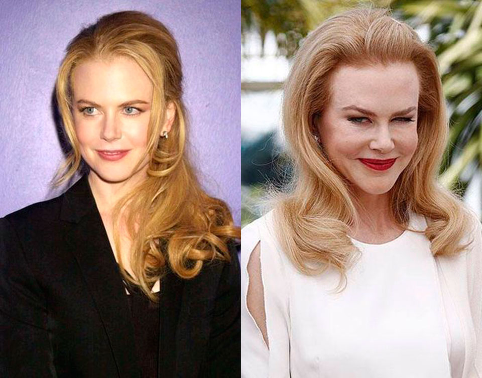 О нежной дружбе Николь Кидман с инъекциями ботулотоксина не писал только ленивый. В какой-то момент актриса так «заигралась», что ее лицо стало похоже на застывшую маску. В 2011 году Николь рассказала о своей зависимости журналистам: «Да,к сожалению, я использовала ботокс… Но это уже в прошлом. Сейчас мое лицо, наконец,вновь стало подвижным. Моя мимика полностью естественна».