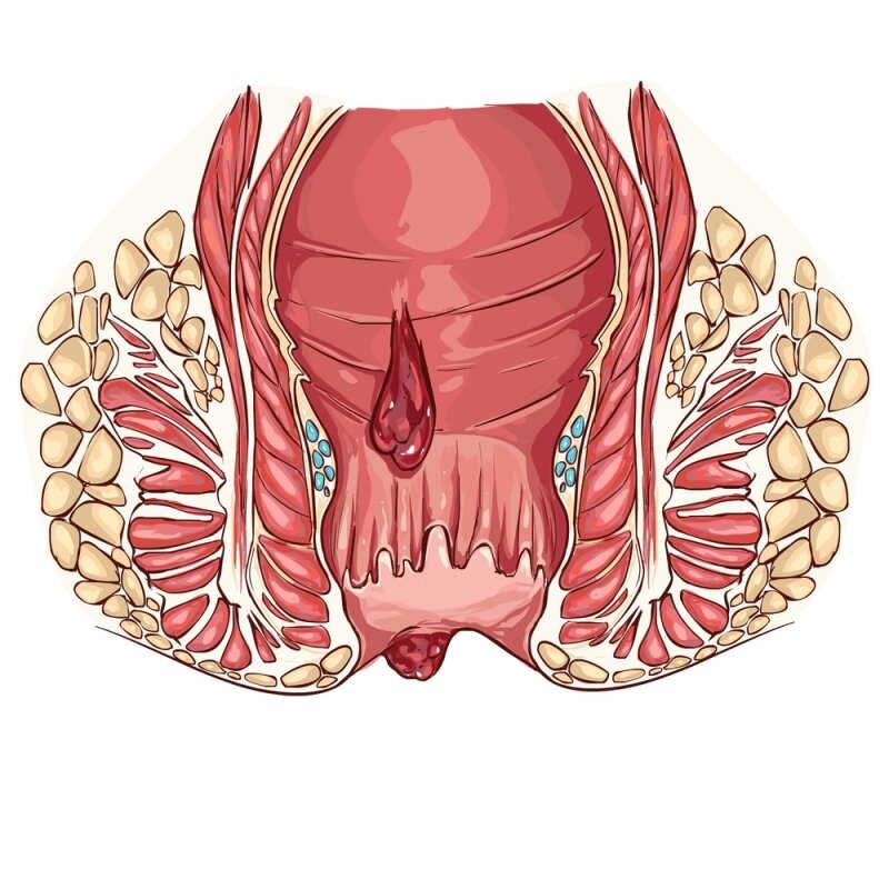 Зуд при геморрое - причины и лечение