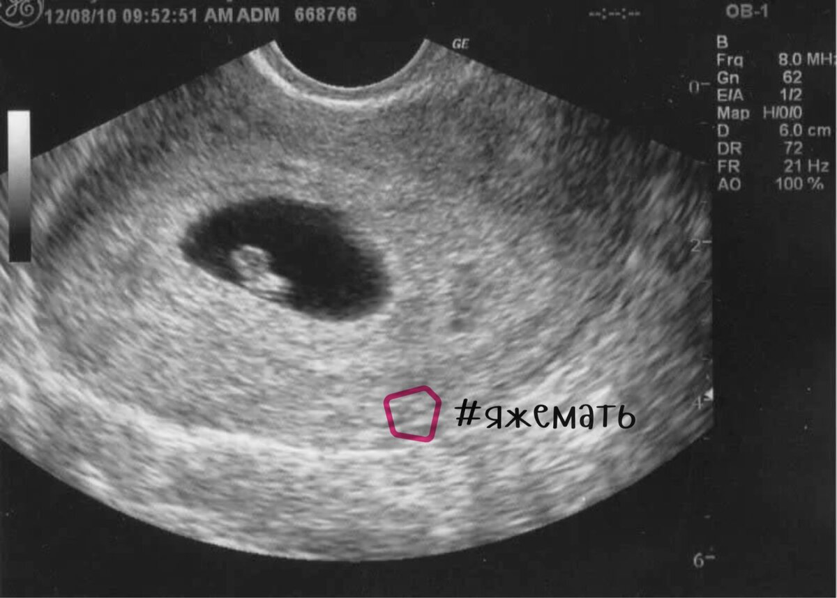6 эмбриональная неделя. 5-6 Недель беременности фото плода на УЗИ. Эмбрион на 6 неделе беременности УЗИ. Фото эмбриона на 6 неделе беременности на УЗИ.