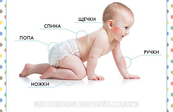  Кожная   аллергия   у малыша 