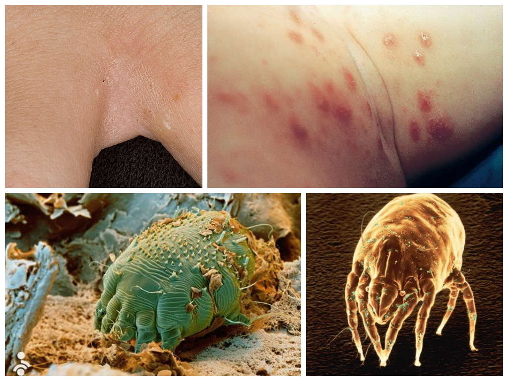 Укусы постельного клеща выглядят как аллергическое раздражение на коже