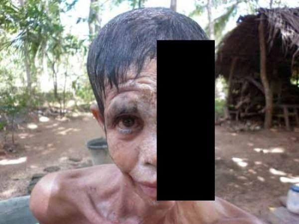 Некротический фасциит 